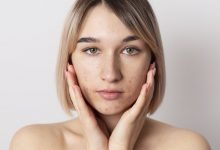 Clínica Goiânia - Acne: mitos e verdades