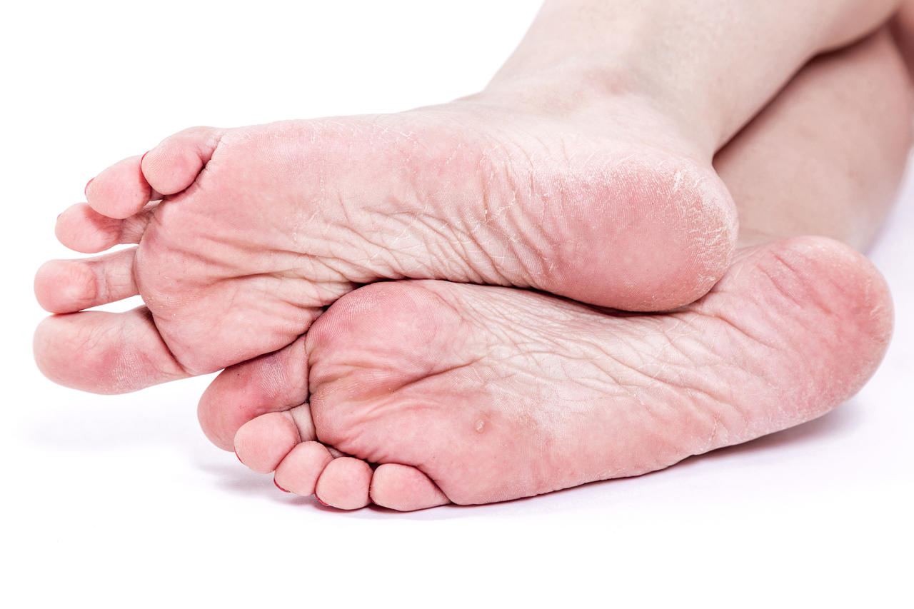 Pronto Socorro para Queimaduras - O que é úlcera do pé diabético? 