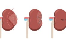 Clínica Urologia de Goiânia - Quando indicar Nefrectomia Parcial Robótica