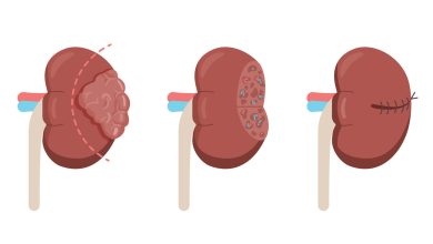 Clínica Urologia de Goiânia - Quando indicar Nefrectomia Parcial Robótica
