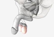 Urologista Aparecida de Goiânia - Torção testicular uma emergência urológica