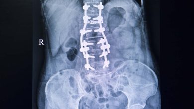 Ortopedia Goiânia - Quando a artrodese da coluna é indicada?