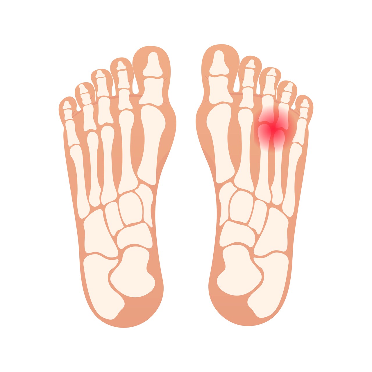 Ortopedia Goiânia - Você sabe o que é o neuroma de morton