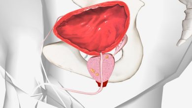Urologia Goiânia - Diagnóstico precoce é fundamental para aumentar as chances de cura do câncer de próstata!