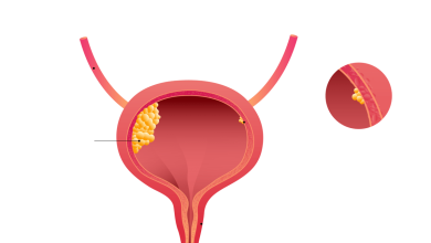 Urologia Goiânia - Por que a prostatectomia radical robótica é tão eficaz?