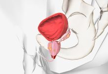 Urologia Aparecida de Goiânia - Quando a prostatectomia radical é indicada?