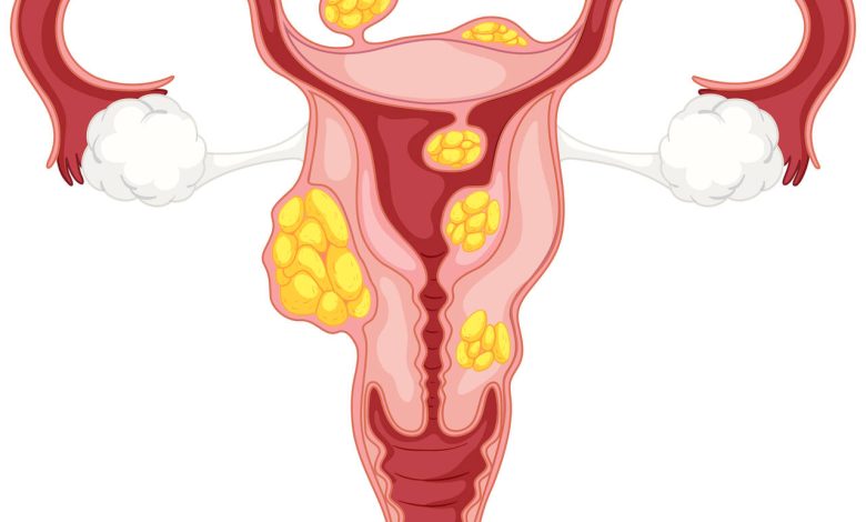 Miomas uterino qual tipo de ultrassom fazer
