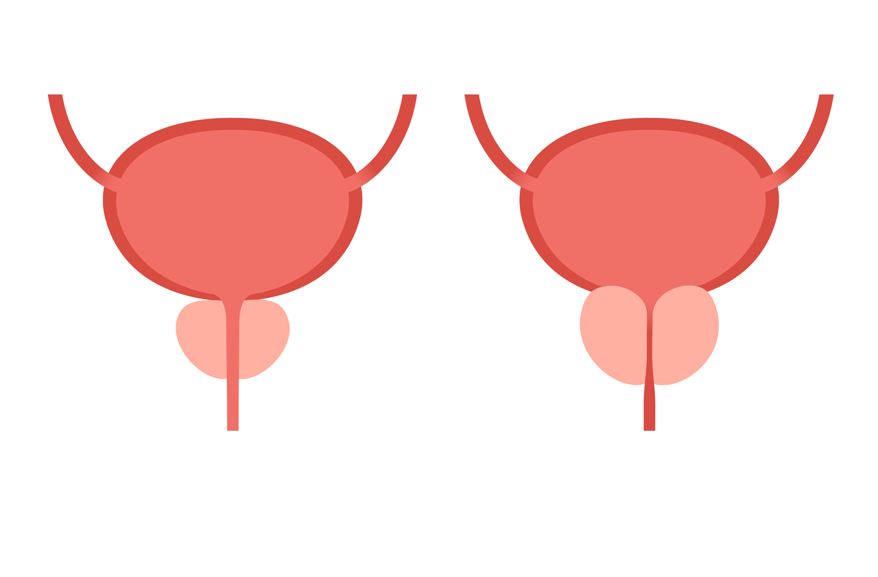 Urologia Goiânia - Como é feita a cirurgia ressecção transuretral da próstata?