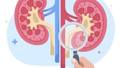 É possível quebrar cálculos renais sem precisar de cirurgia?
