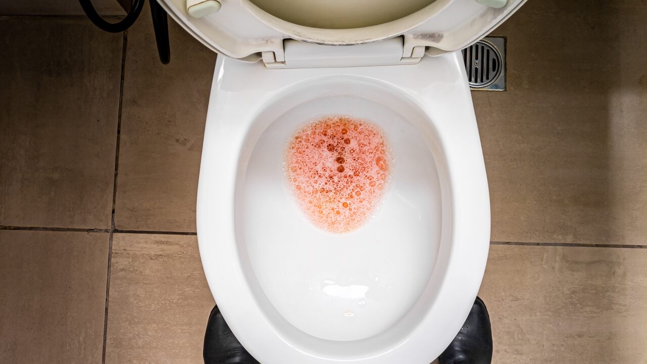 Alerta Vermelho: Sangue na urina pode ser sinal de tumor na bexiga?