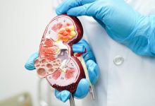 Transformando cirurgias com tecnologia - o avanço da nefrectomia robótica no campo da urologia