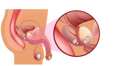 Prostatectomia: entenda quais são os tipos e quando é necessária!