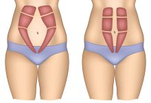 Cirurgia plástica Brasília: É possível corrigir a diástase abdominal sem realizar uma abdominoplastia completa?