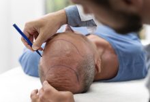 Dra. Lorena Rosique Cirurgiã Plástica - Transplante capilar: recuperação rápida e resultados naturais