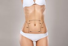 É possível fazer abdominoplastia e mastopexia juntas?