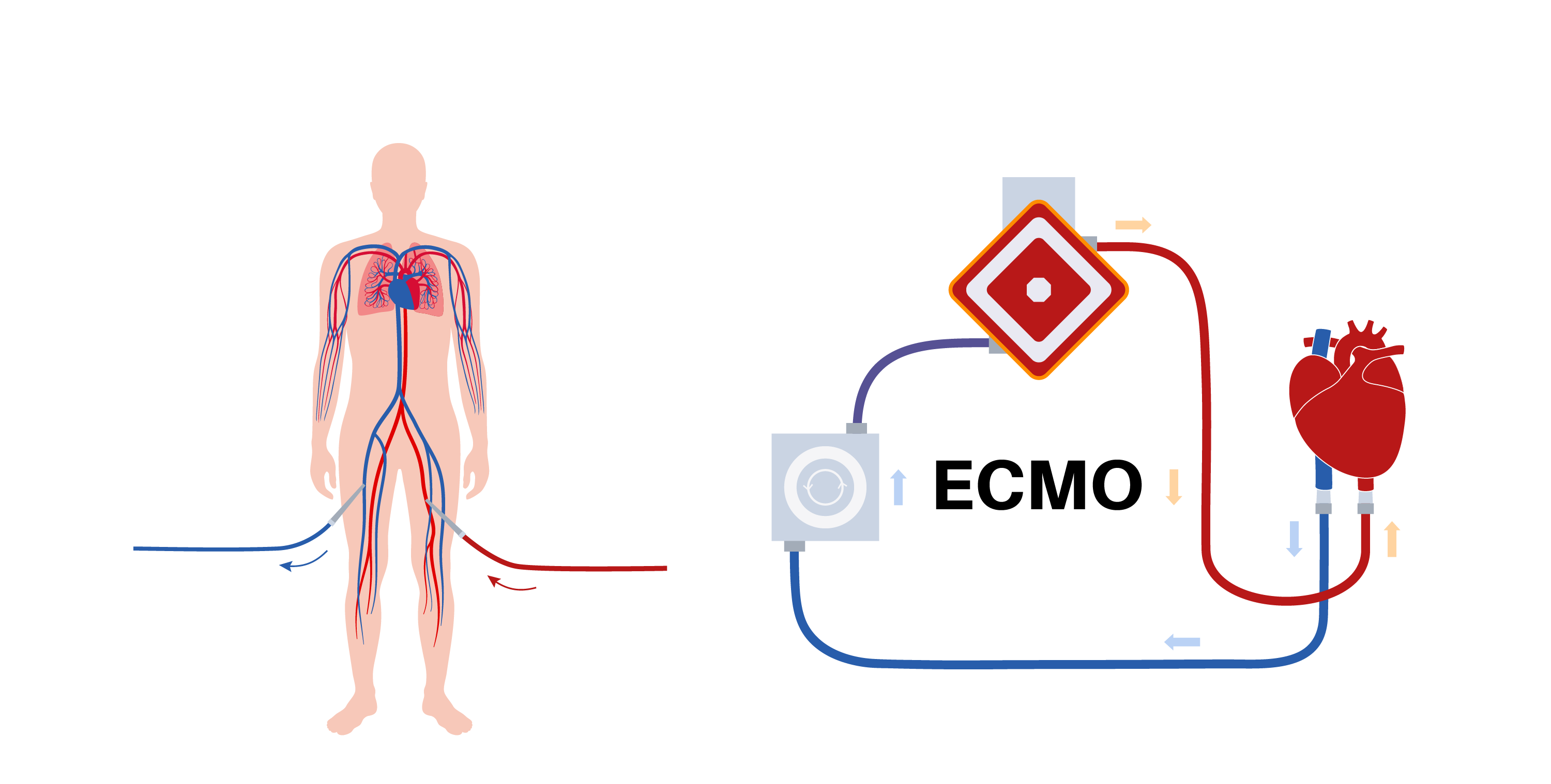 ECMO suporte vital para o coração e os pulmões