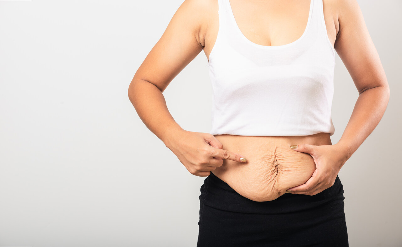 Abdominoplastia em âncora entenda a cirurgia indicada para quem perdeu muito peso, com orientações do Dr. Reyner Abrantes Stival