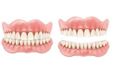 Prótese overdenture a alternativa moderna às dentaduras tradicionais com mais estabilidade e conforto