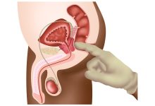 Saúde do homem Dr. Marco Túlio Cruvinel, urologista em Goiânia, explica como é feito o diagnóstico do câncer de próstata