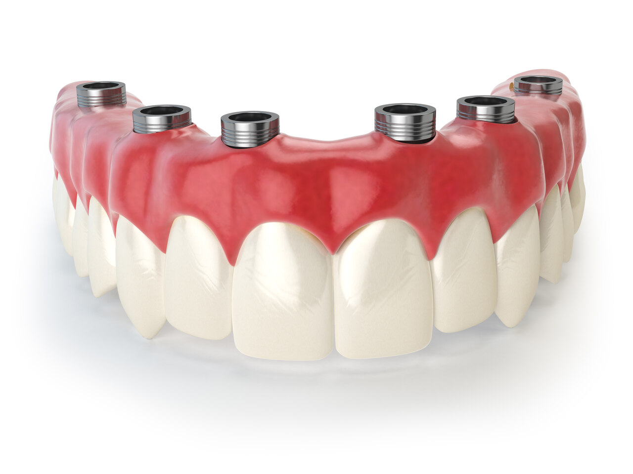Prótese protocolo e prótese overdenture qual a diferença