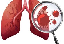 Entenda o papel da tomografia no diagnóstico da Influenza A e Vírus Sincicial Respiratório (VSR)