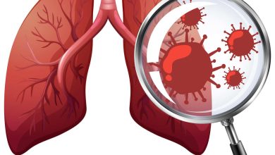 Entenda o papel da tomografia no diagnóstico da Influenza A e Vírus Sincicial Respiratório (VSR)