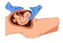 O que ninguém te conta sobre a cesárea
