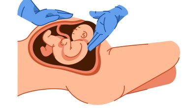 O que ninguém te conta sobre a cesárea