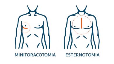 - Por que a minitoracotomia está ganhando espaço na cirurgia cardíaca moderna