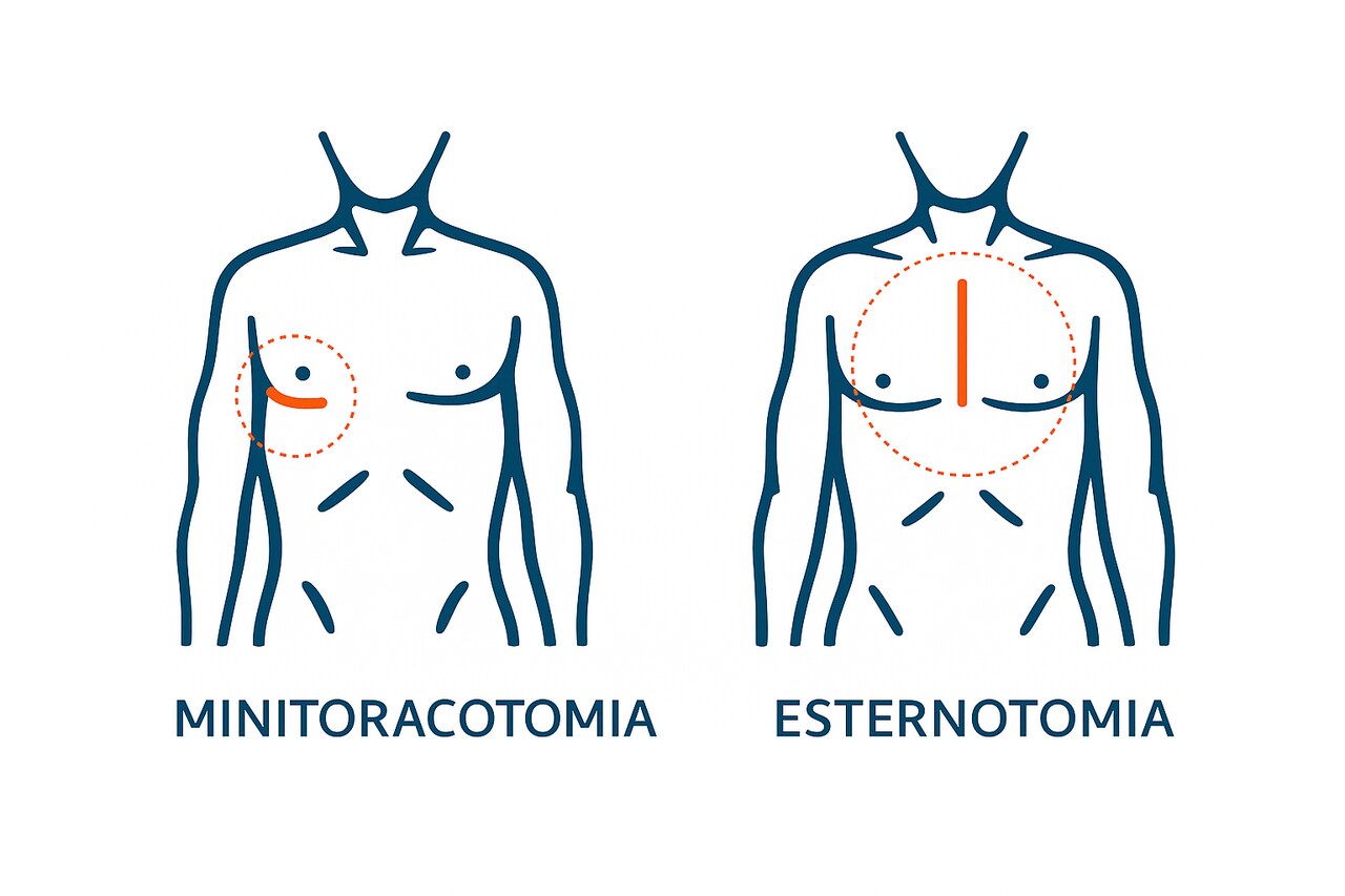 - Por que a minitoracotomia está ganhando espaço na cirurgia cardíaca moderna