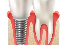 Qual implante dentário é o certo para você Conheça os principais tipos!