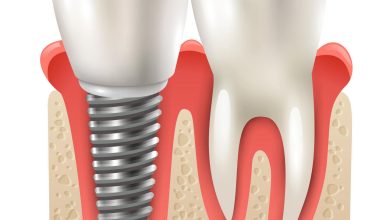 Qual implante dentário é o certo para você Conheça os principais tipos!