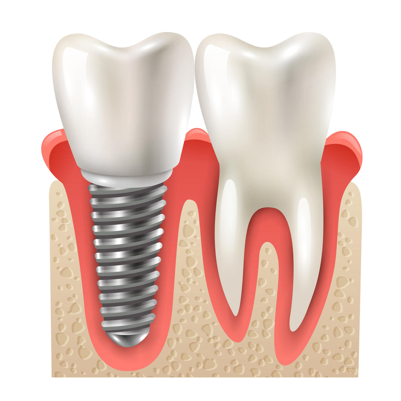 Qual implante dentário é o certo para você Conheça os principais tipos!