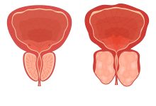 REZUM ou HoLEP Qual a melhor cirurgia para a hiperplasia prostática benigna (HPB