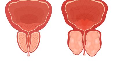 REZUM ou HoLEP Qual a melhor cirurgia para a hiperplasia prostática benigna (HPB