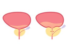 Sintomas parecidos, diagnósticos diferentes como saber se é HPB ou prostatite
