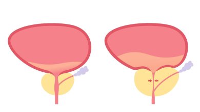 Sintomas parecidos, diagnósticos diferentes como saber se é HPB ou prostatite