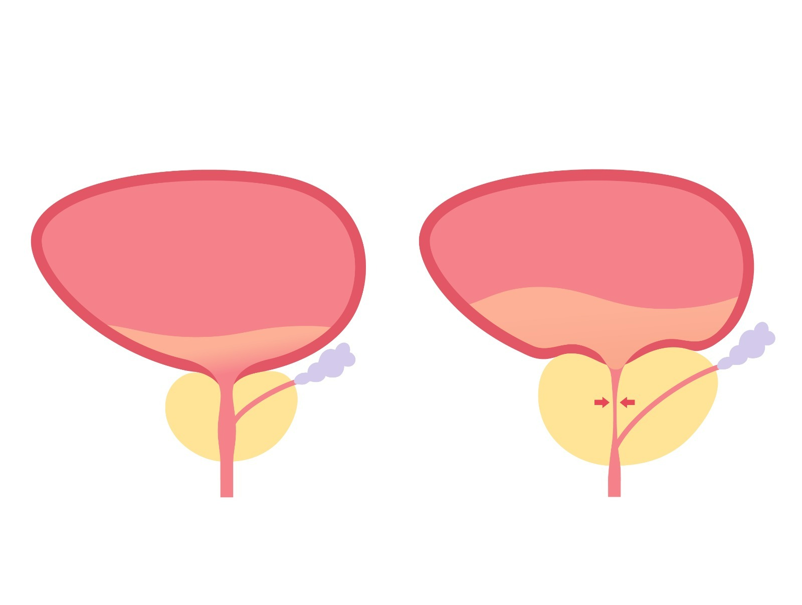 Sintomas parecidos, diagnósticos diferentes como saber se é HPB ou prostatite
